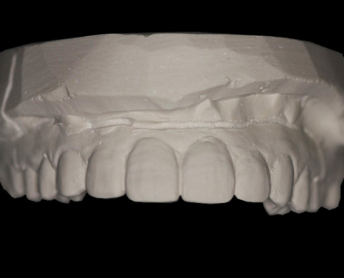 Prosthetics